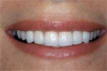 After Porcelain Veneers