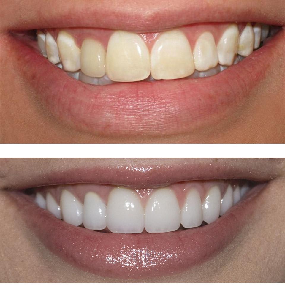 Porcelain Veneers Melbourne