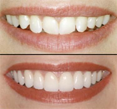 Porcelain Veneers Melbourne