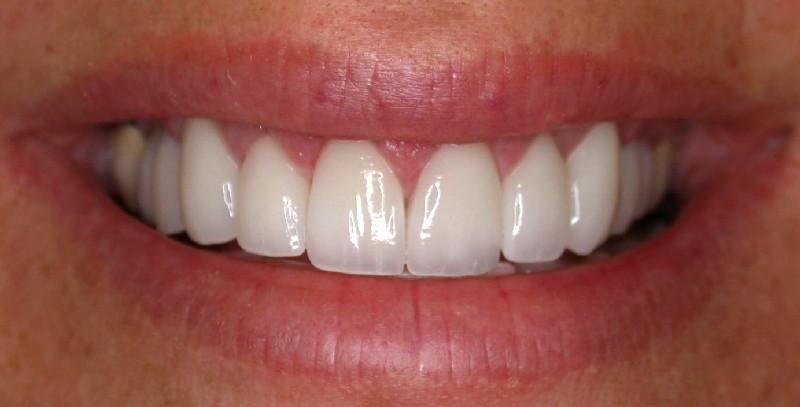 Advantage of Porcelain Veneers