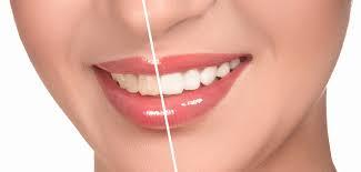 Porcelain Veneers