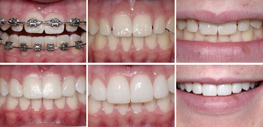 Porcelain Veneers Melbourne