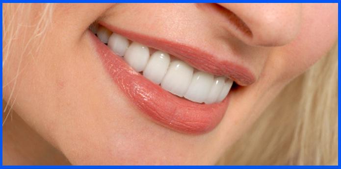 Porcelain Veneers