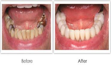 Root Canal Treatment