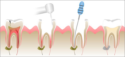 Root Canal Treatment