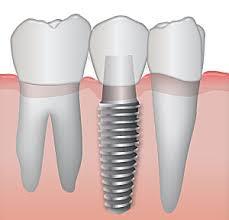 Dental Implants Melbourne