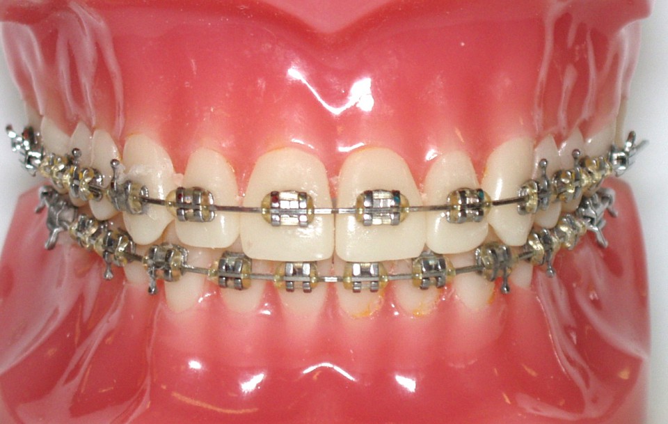 orthodontic braces