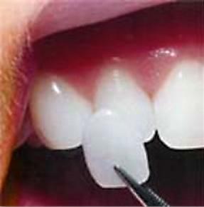 Porcelain Veneers