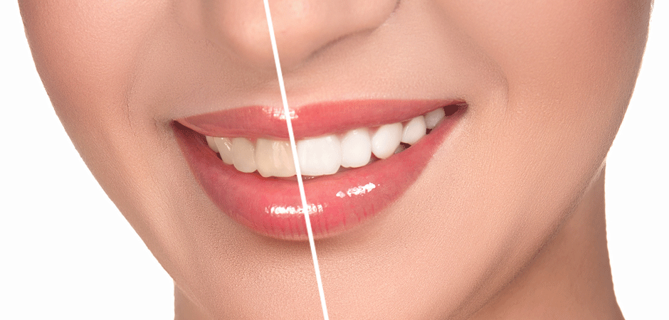 Porcelain Veneers Melbourne