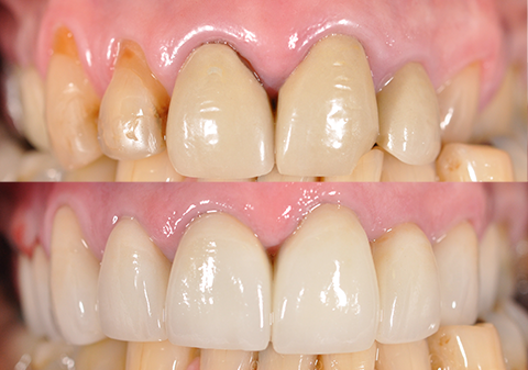 Porcelain Veneers Melbourne