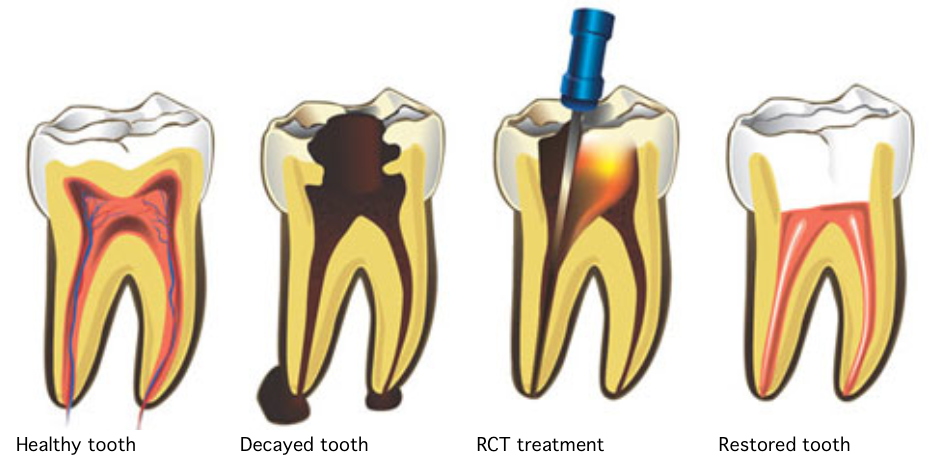 Root Canal Treatment