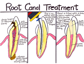 Root Canal Treatment