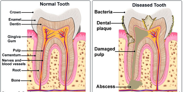 Root Canal Treatment Melbourne