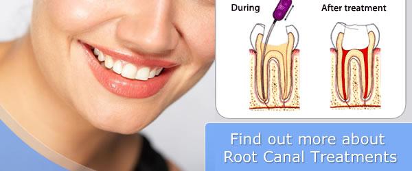 Root Canal Treatment Melbourne