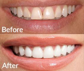 Porcelain Veneers